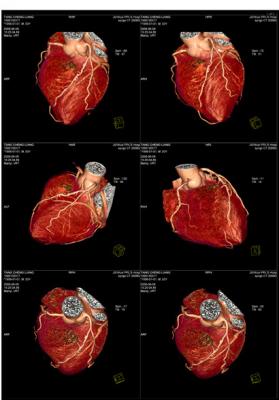 醫(yī)用ct膠片-心臟