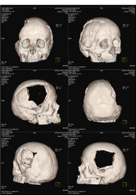 醫用ct膠片-頭骨