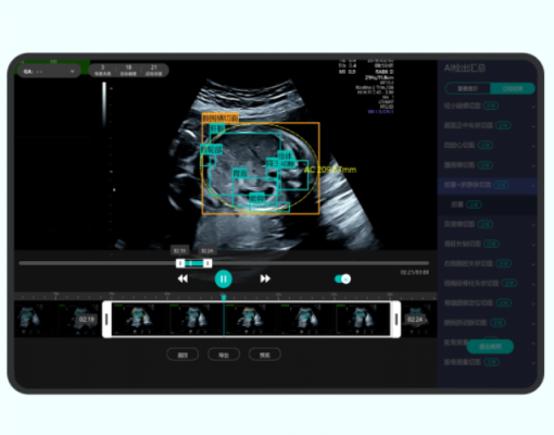 產(chǎn)前動態(tài)超聲影像處理系統(tǒng)airiscan q6