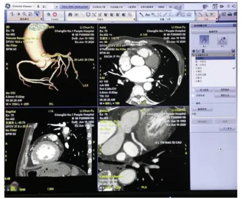 冠脈ct造影圖像血管狹窄輔助評估軟件inferread cta coronary