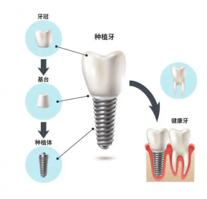 牙種植體基臺(tái)系統(tǒng) 春立正達(dá)