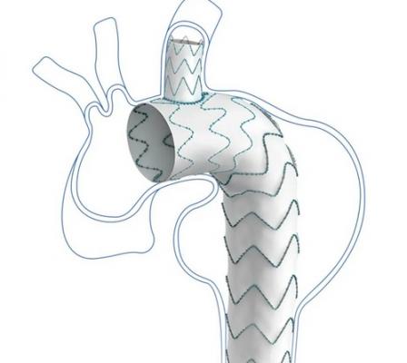 戈爾分支型胸主動脈覆膜血管內(nèi)支架系統(tǒng)gore