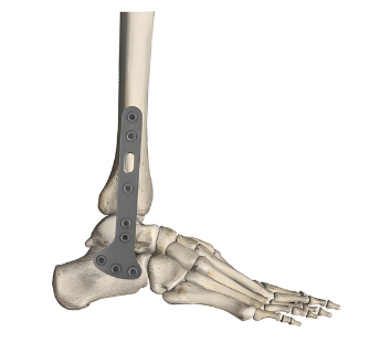 奧斯邁足踝鎖定接骨板系統