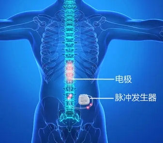  體外脊髓神經(jīng)刺激測(cè)試系統(tǒng)