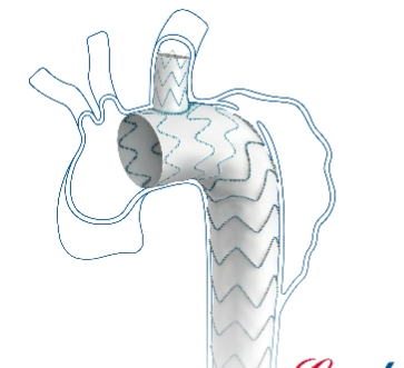  可主動調控胸主動脈覆膜支架系統